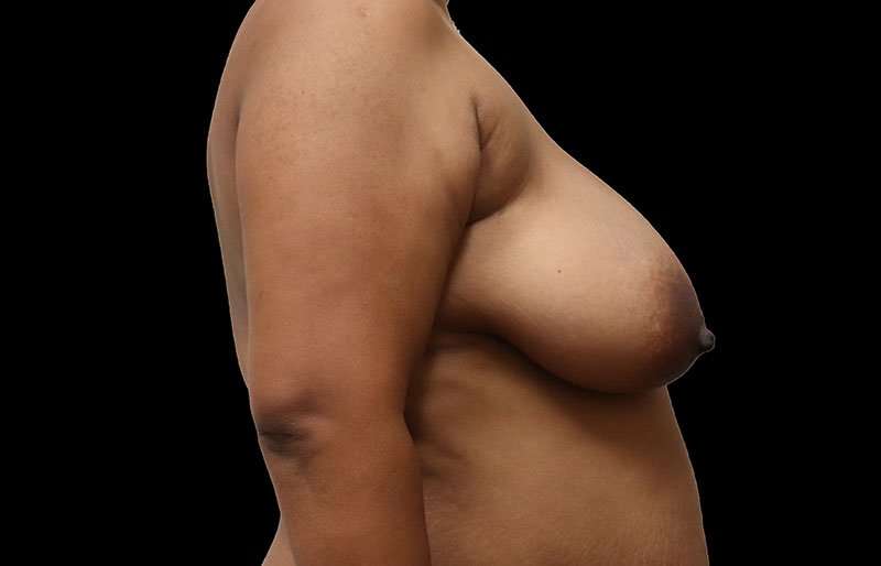 Breast Reduction Before & After Patient #1354