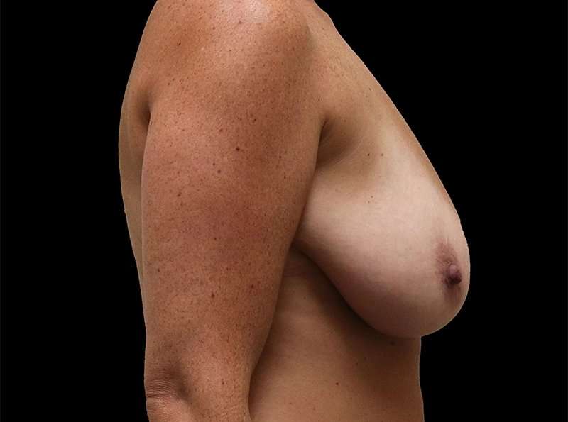 Breast Reduction Before & After Patient #1365