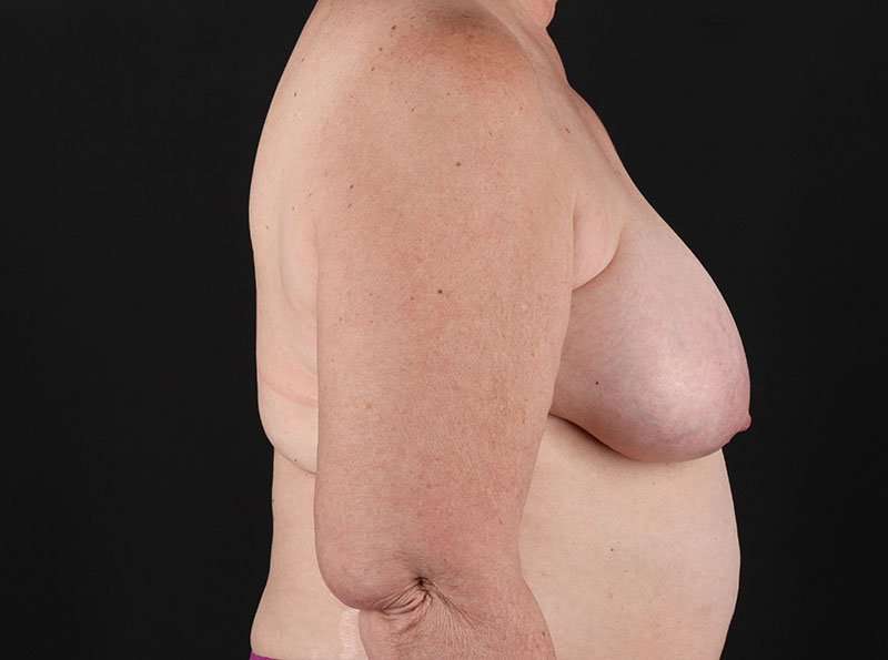 Breast Reduction Before & After Patient #1376