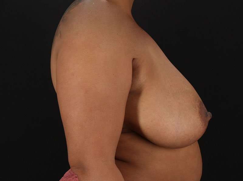 Breast Reduction Before & After Patient #1387