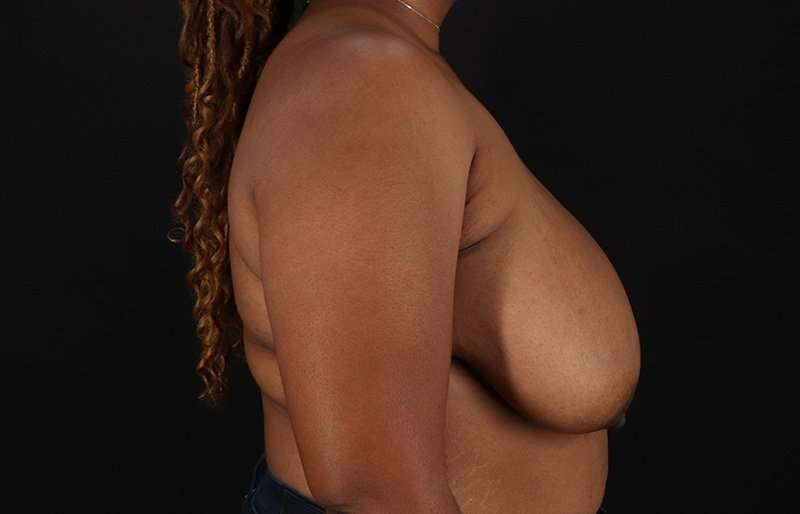 Breast Reduction Before & After Patient #1431