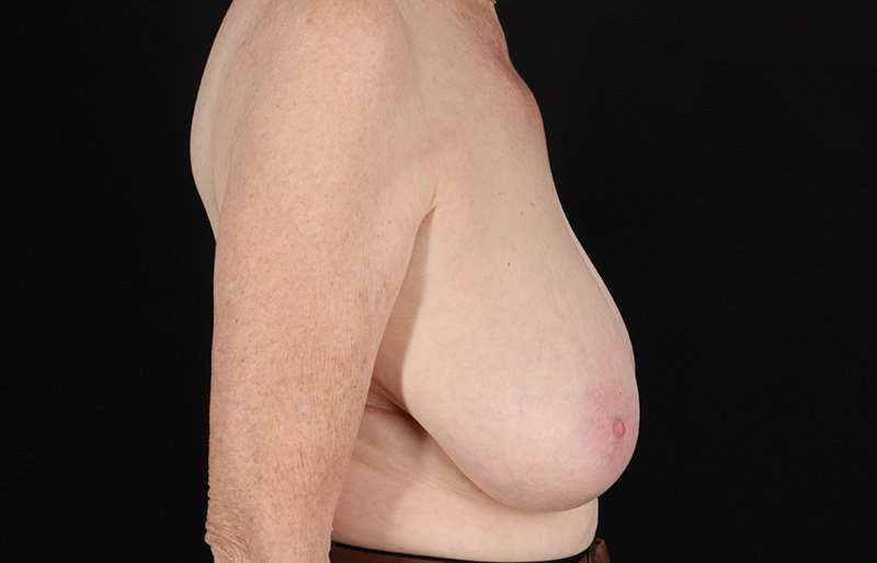 Breast Reduction Before & After Patient #1442