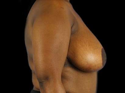 Breast Reduction Before & After Patient #1475