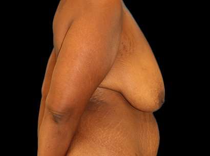 Breast Reduction Before & After Patient #1486