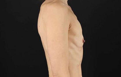 Breast Augmentation - Implant Before & After Patient #943