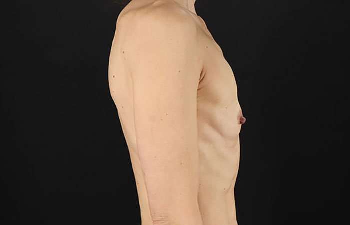 Breast Augmentation - Implant Before & After Patient #943