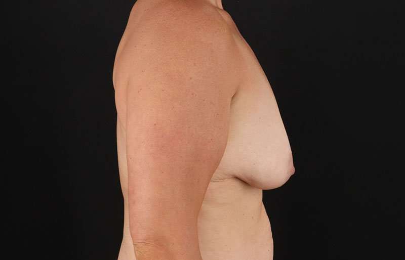 Augmentation/Lift Before & After Patient #1522