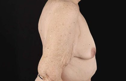 Augmentation/Lift Before & After Patient #1544