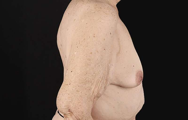 Augmentation/Lift Before & After Patient #1544