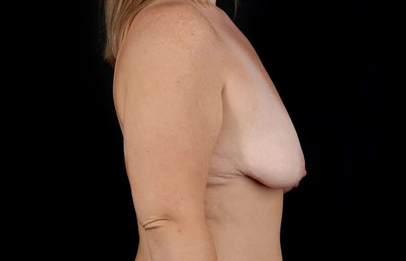 Augmentation/Lift Before & After Patient #1568