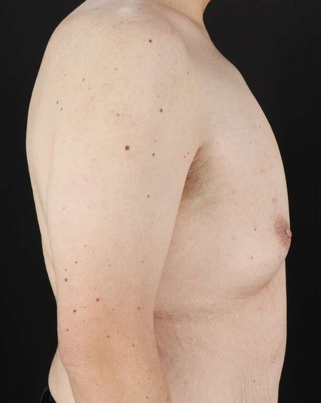 Gynecomastia Before & After Patient #1603