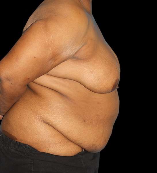 DIEP Flap Reconstruction Before & After Patient #1623