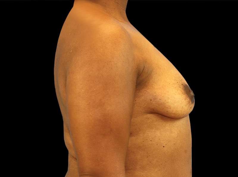 Breast Augmentation - Implant Before & After Patient #954