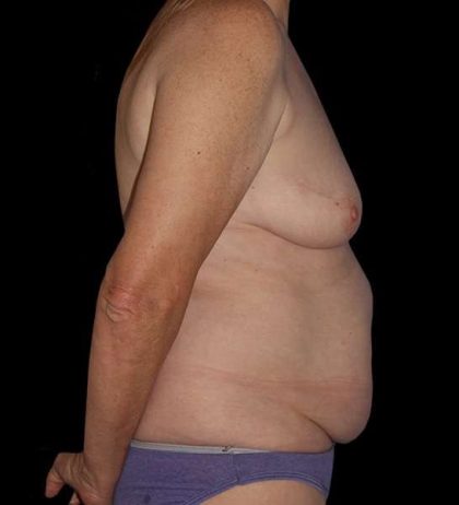 DIEP Flap Reconstruction Before & After Patient #1634