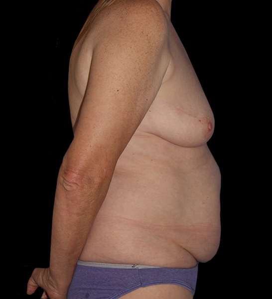 DIEP Flap Reconstruction Before & After Patient #1634