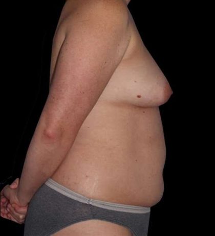 DIEP Flap Reconstruction Before & After Patient #1645