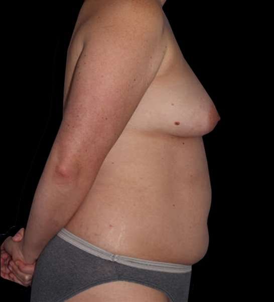 DIEP Flap Reconstruction Before & After Patient #1645
