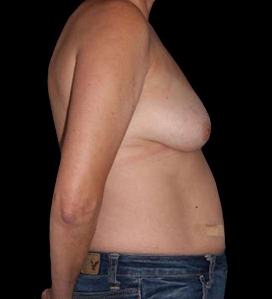 DIEP Flap Reconstruction Before & After Patient #1652