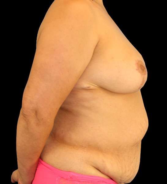 DIEP Flap Reconstruction Before & After Patient #1663