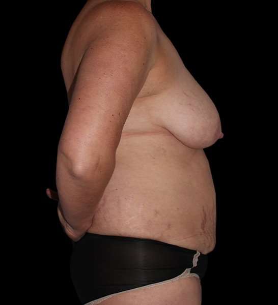 DIEP Flap Reconstruction Before & After Patient #1674