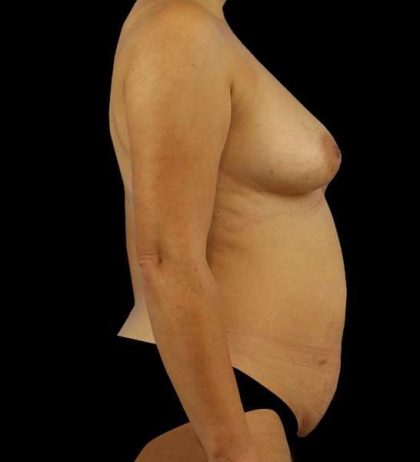 DIEP Flap Reconstruction Before & After Patient #1685