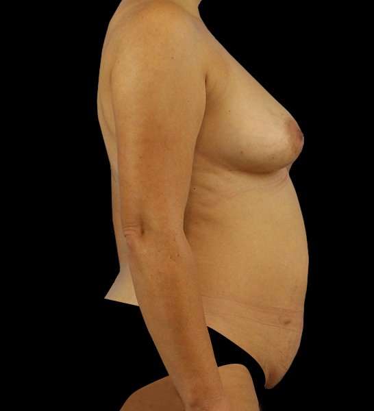 DIEP Flap Reconstruction Before & After Patient #1685