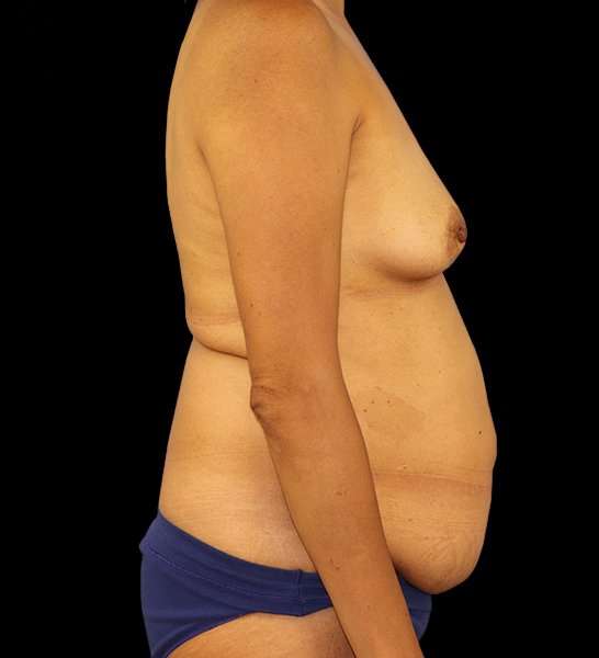 DIEP Flap Reconstruction Before & After Patient #1696
