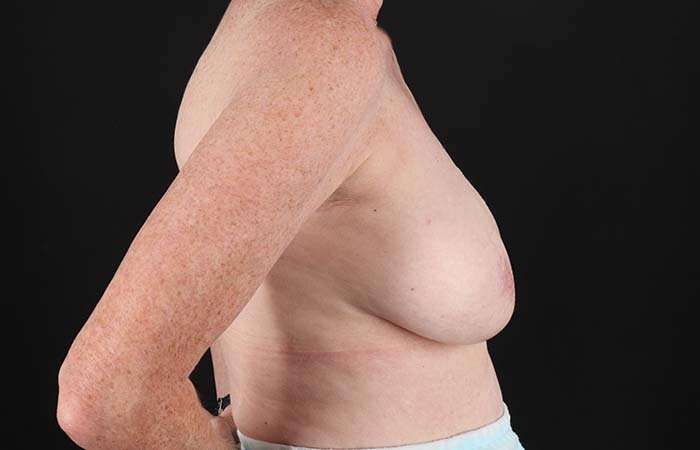 Implant Based Breast Reconstruction Before & After Patient #1718
