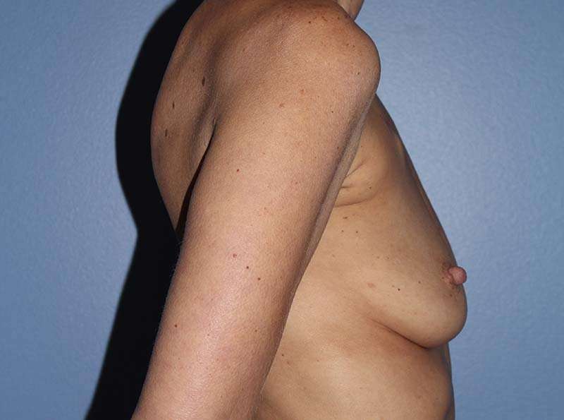 Implant Based Breast Reconstruction Before & After Patient #1729