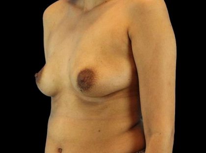 Breast Augmentation - Implant Before & After Patient #961