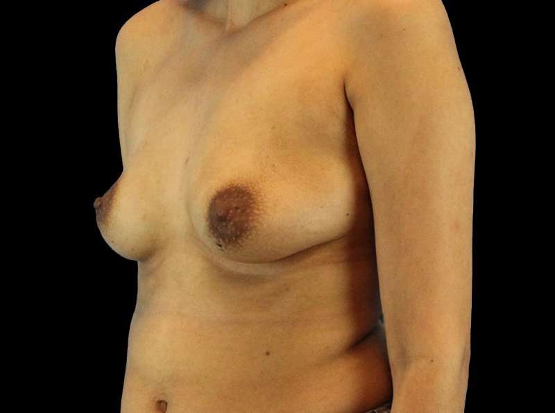 Breast Augmentation - Implant Before & After Patient #961
