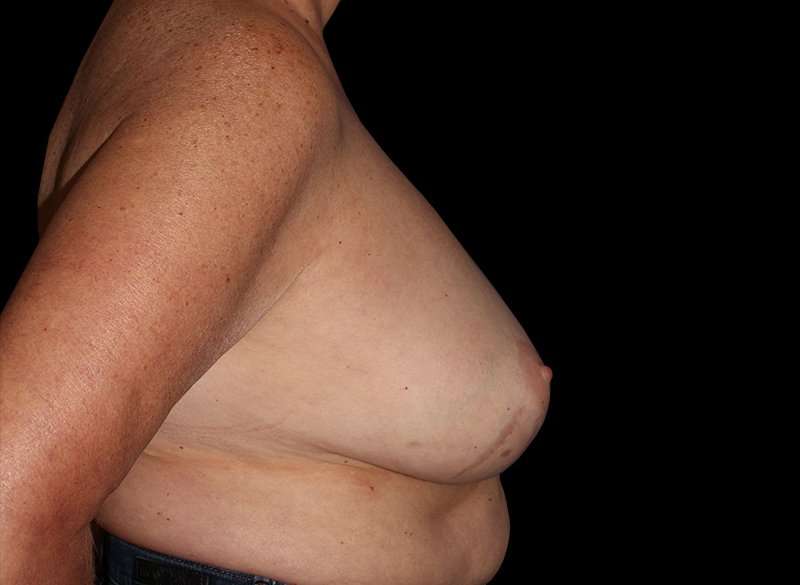 Oncoplastic Reconstruction Before & After Patient #1762