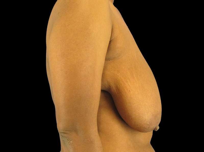 Oncoplastic Reconstruction Before & After Patient #1784