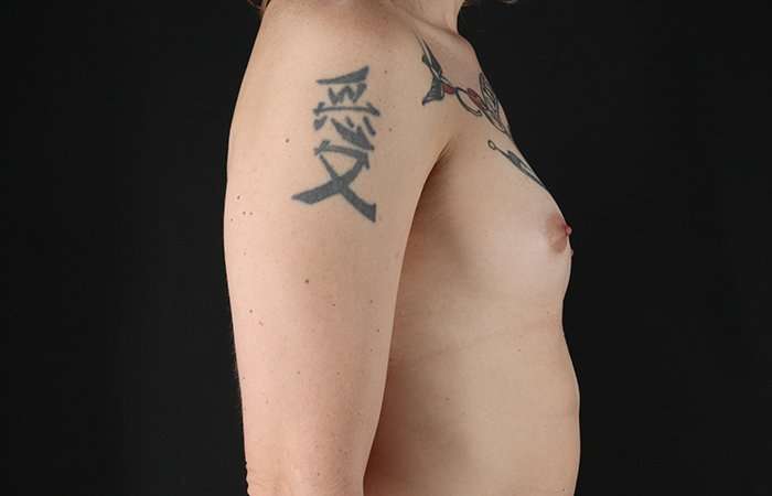 MTF Breast Augmentation Before & After Patient #1795