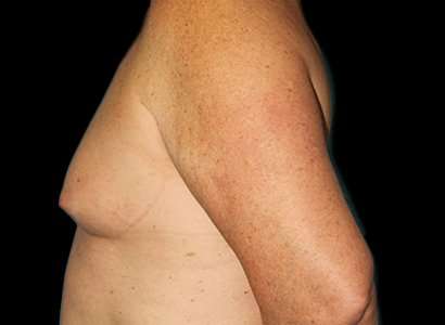 MTF Breast Augmentation Before & After Patient #1802