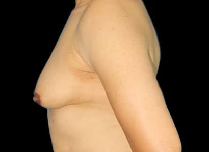 MTF Breast Augmentation Before & After Patient #1809