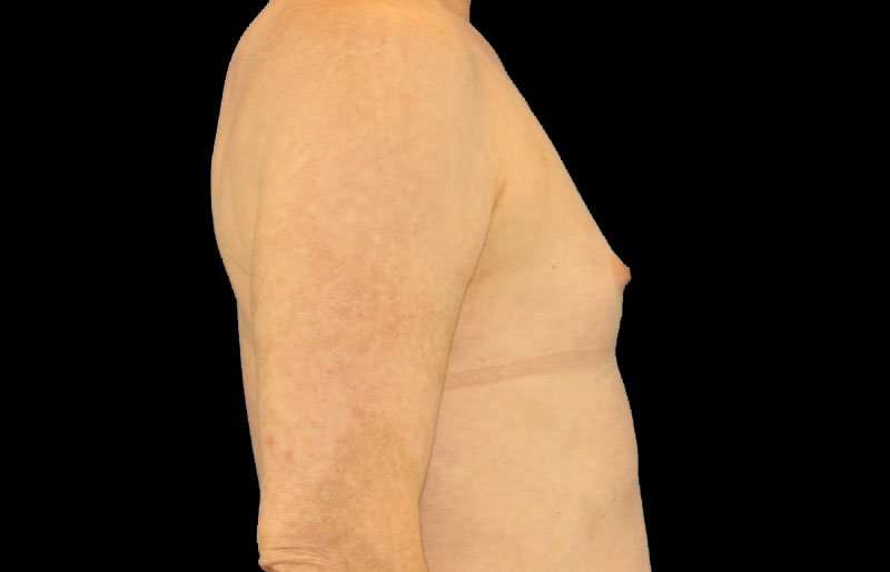 MTF Breast Augmentation Before & After Patient #1820