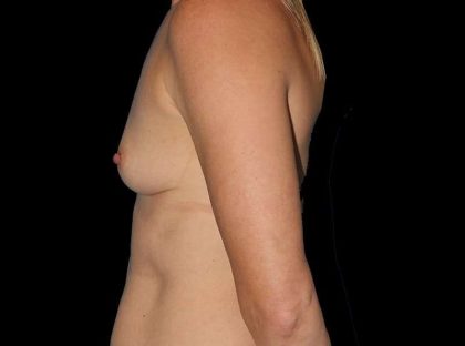Breast Augmentation - Implant Before & After Patient #968