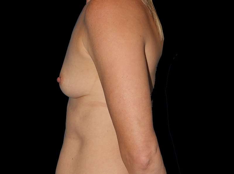 Breast Augmentation - Implant Before & After Patient #968