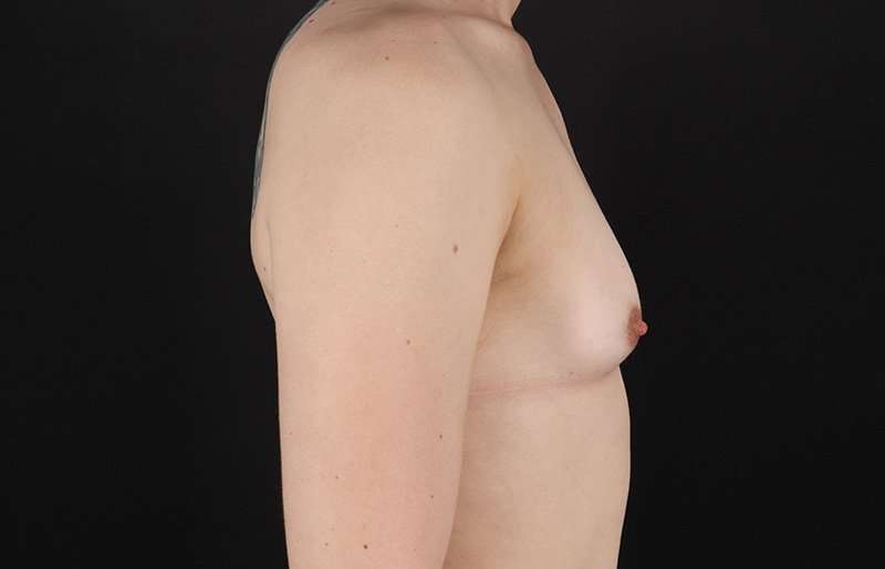 MTF Breast Augmentation Before & After Patient #1842