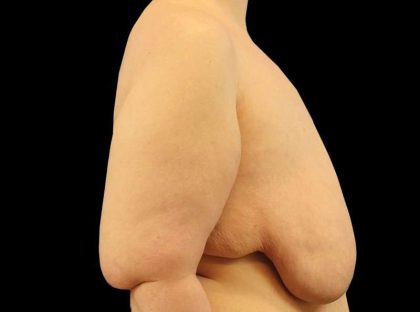 FTM Chest Contouring Before & After Patient #1875