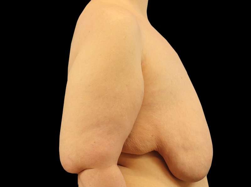 FTM Chest Contouring Before & After Patient #1875