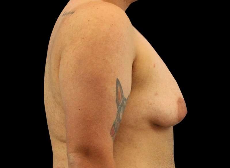 FTM Chest Contouring Before & After Patient #1886