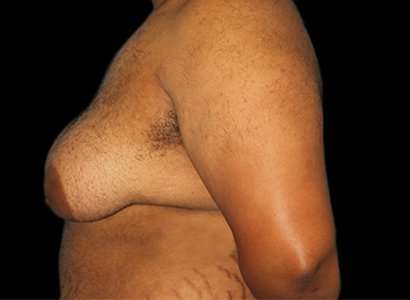 FTM Chest Contouring Before & After Patient #1893