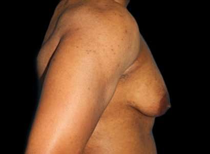 FTM Chest Contouring Before & After Patient #1907