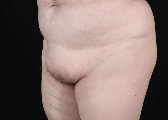 Monsplasty Before & After Patient #2106