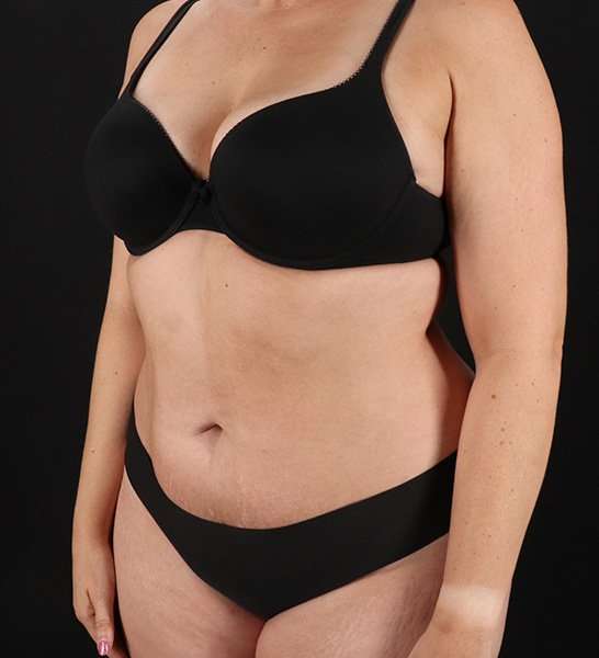 Tummy Tuck Before & After Patient #2128