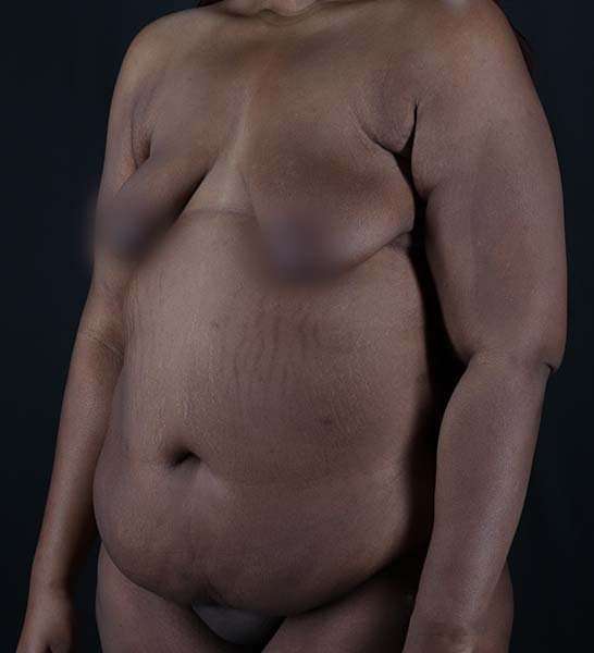 Tummy Tuck Before & After Patient #2139