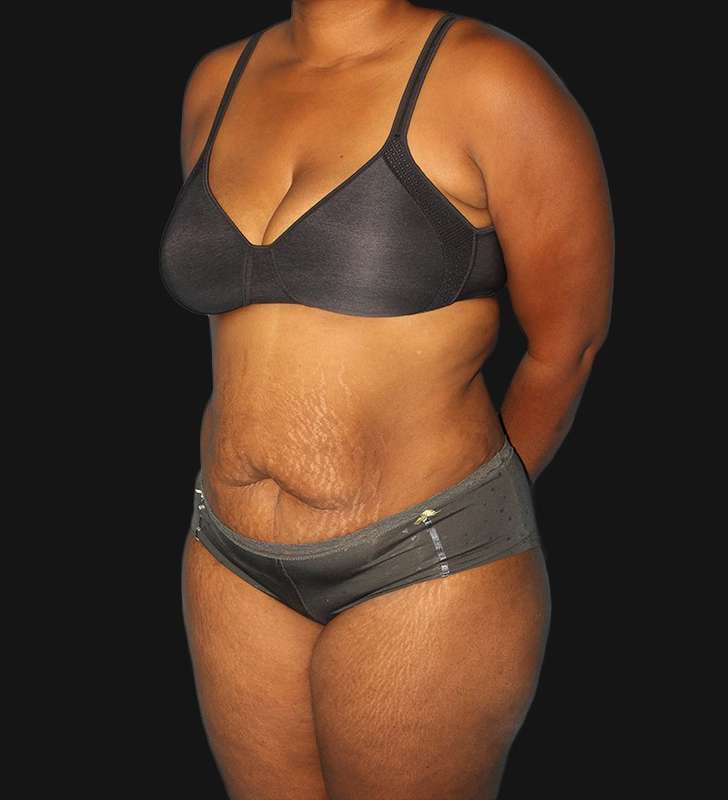 Tummy Tuck Before & After Patient #2179
