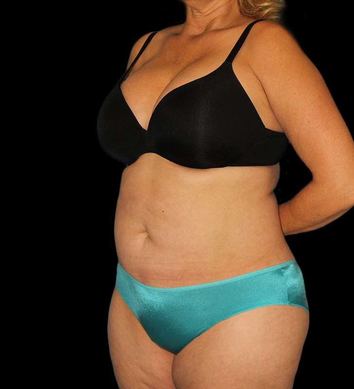 Tummy Tuck Before & After Patient #2190